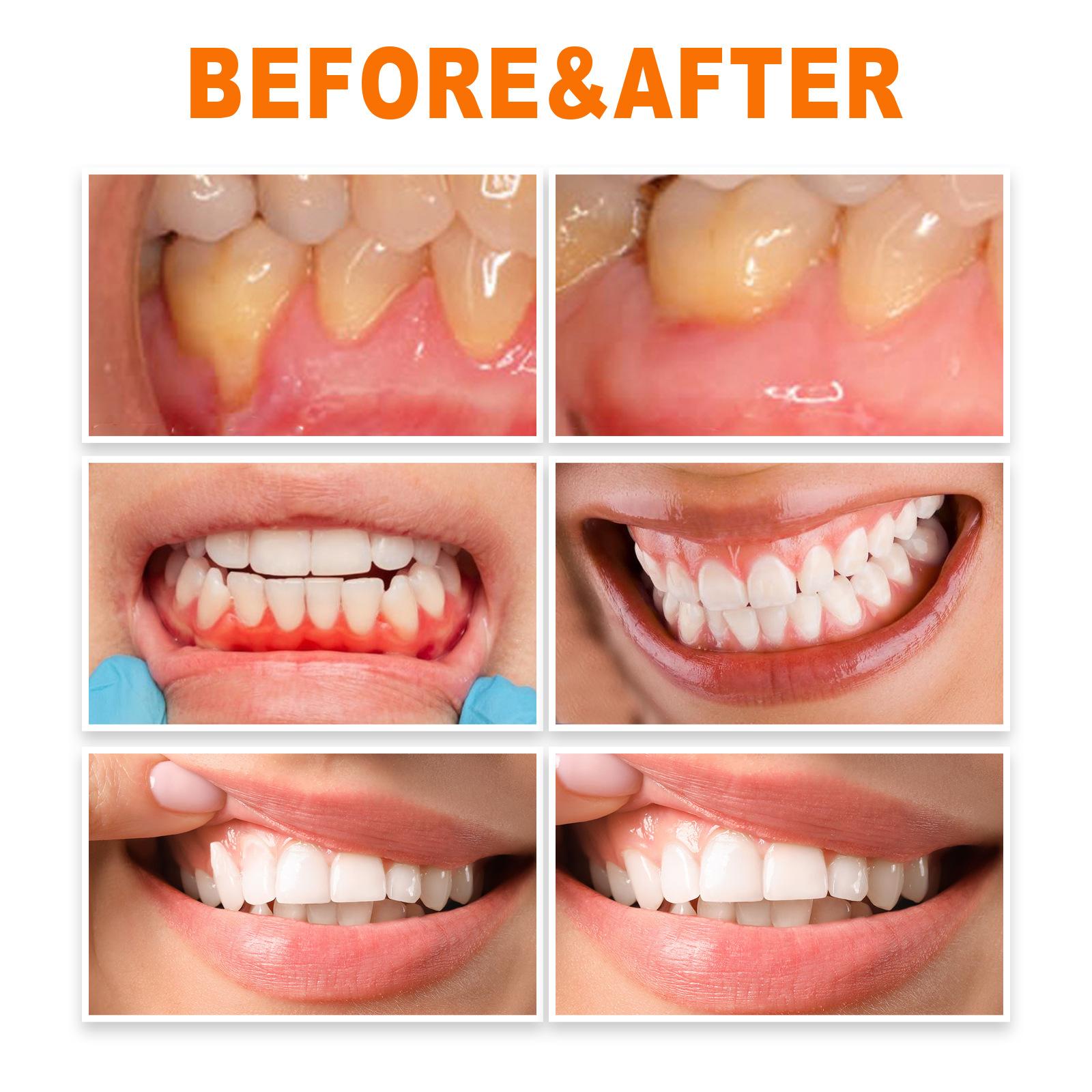 Teeth Repair Deep Cleaning Teeth Yellow Teeth Stain Tartar Care Gum Oral Care 16