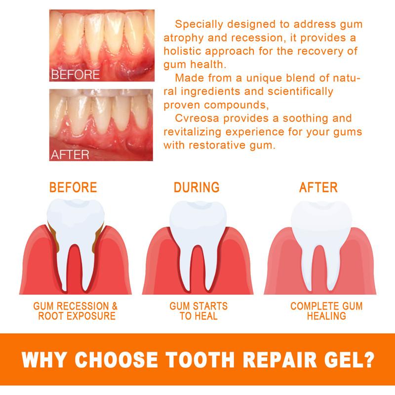 Teeth Repair Deep Cleaning Teeth Yellow Teeth Stain Tartar Care Gum Oral Care 4